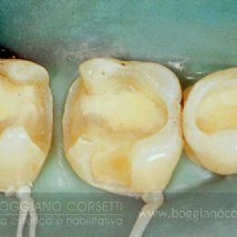 Amalgama dentale