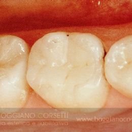 Amalgama dentale