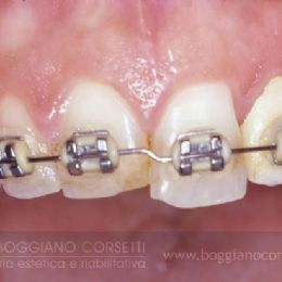 Apparecchio per denti