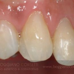 Denti devitalizzati, Dopo