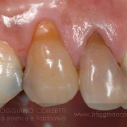 Denti devitalizzati, Prima