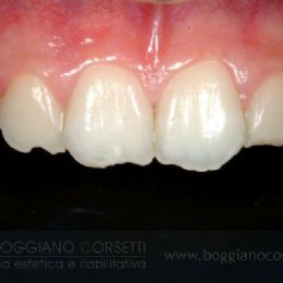 Denti fratturati per abitudini viziate (mordicchiamento della penna) - PRIMA