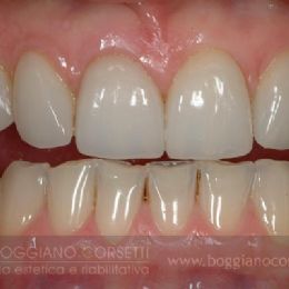 faccette per denti che presentano diastemi