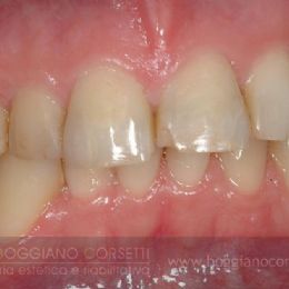 faccette per denti che presentano discromie