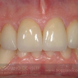 faccette per denti che presentano discromie