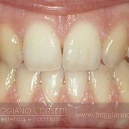 faccette per denti con anomalie di forma