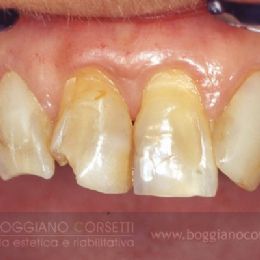 faccette per denti con difetti dello smalto