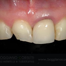 Faccette per denti con forme scorrette o usurate