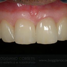 Faccette per denti con forme scorrette o usurate