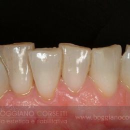 Faccette per ortodonzia istantanea 5