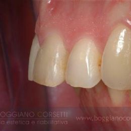 Faccette per ortodonzia istantanea 3