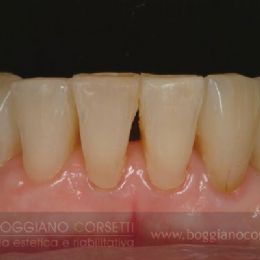 Faccette per ortodonzia istantanea 2