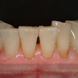 Faccette per ortodonzia istantanea 1