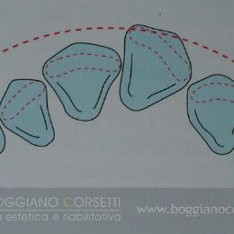 Faccette per ortodonzia istantanea