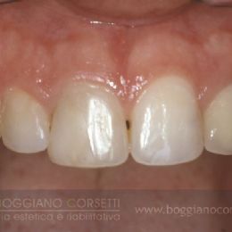 faccette per otturazioni con difetti di colore