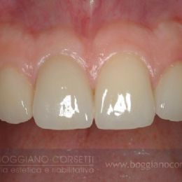 faccette per otturazioni con difetti di colore