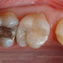 Intarsi dentale in ceramica
