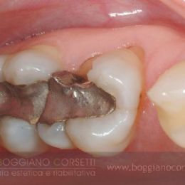 Intarsi dentale in ceramica