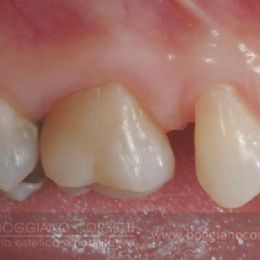 Intarsi dentale in ceramica