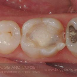 Intarsi dentale in ceramica