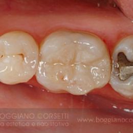 Intarsi dentale in composito