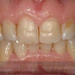 Restauro in composito di denti con abrasione da spazzolamento - PRIMA