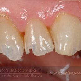Ricostruzione delle superfici occlusali abrase da digrignamento (bruxismo) - PRIMA