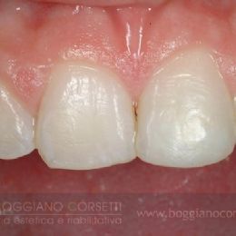 Ricostruzione in composito per ricreare la simmetria dei due centrali - DOPO