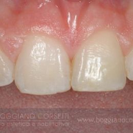 Ricostruzione in composito per ricreare la simmetria dei due centrali - PRIMA