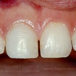 Ricostruzione estetica di un dente fratturato per trauma - DOPO