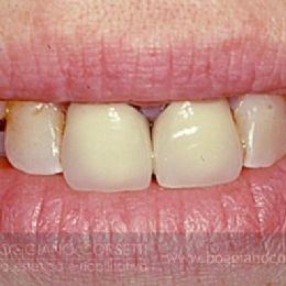 Sostituzione corone dentali con bordo metallico