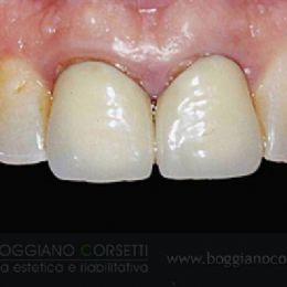 Sostituzione corone dentali con bordo metallico