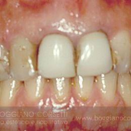Sostituzione corone dentali con bordo metallico