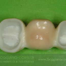 Sostituzione corone dentali con bordo metallico