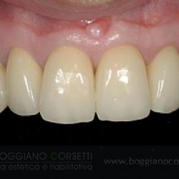 Sostituzione corone dentali con bordo metallico