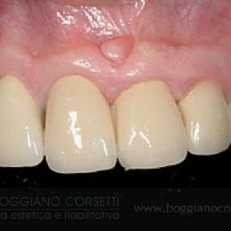 Sostituzione corone dentali con bordo metallico
