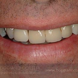 Sostituzione corone dentali con bordo metallico