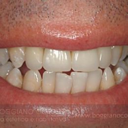 Sostituzione corone dentali con bordo metallico