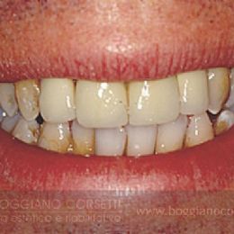Sostituzione corone dentali con bordo metallico