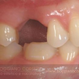 Sostituzione corone dentali in ceramica