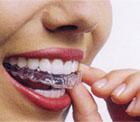 Invisalign� Apparecchio invisibile