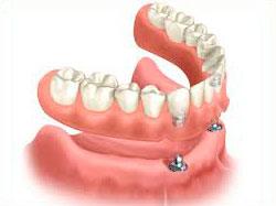 overdenture